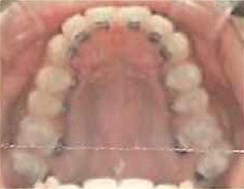 orthodontics-img03